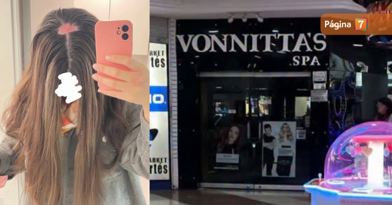 Peluquería de Quilpué presenta recurso de protección contra joven que sufrió graves quemaduras