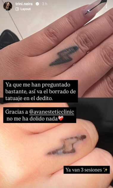 Trini Neira mostró cómo avanza el borrado de sus tatuajes: "No me ha dolido nada"