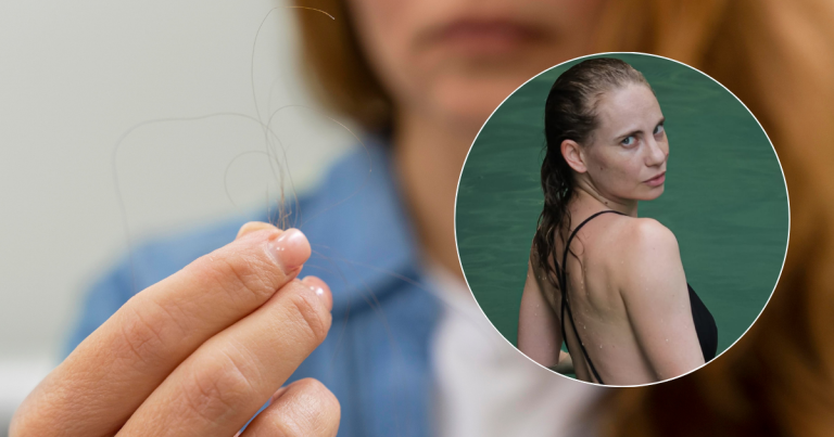 Alopecia femenina: la enfermedad que afecta a Li Fridman y que sería cada vez más común