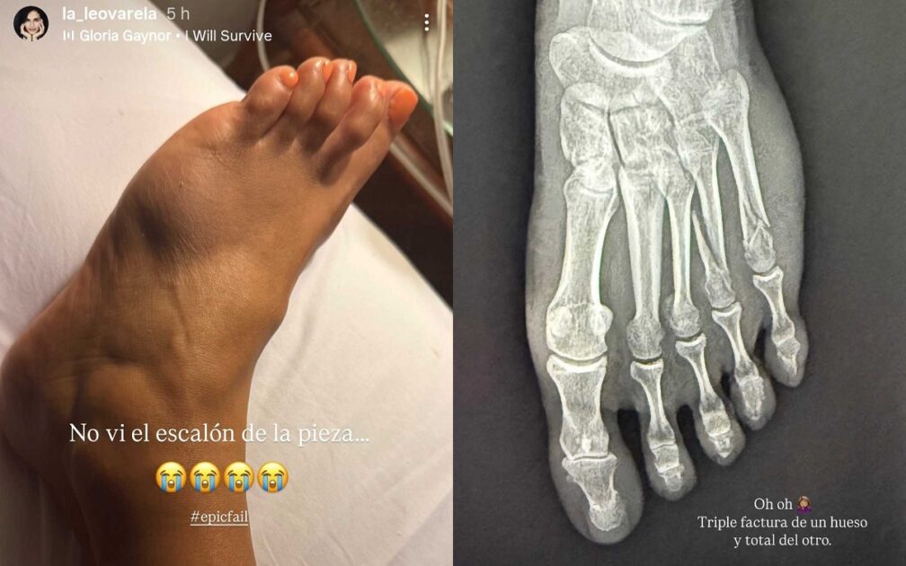 Leonor Varela sufrió fractura tras doloroso accidente