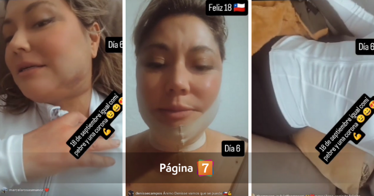 Denisse Campos registró resultados tras múltiples intervenciones estéticas: 