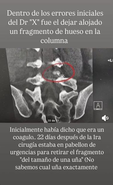 Pamela denunció mala praxis tras operación por fragmento de hueso en su columna