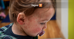 Confirman primer caso de sarampión en Chile desde 2023: ¿Qué hacer si tengo alguno de los síntomas?