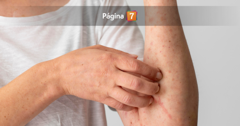 Nuevo caso importado de sarampión: cómo identificar los síntomas y qué hacer si presento alguno